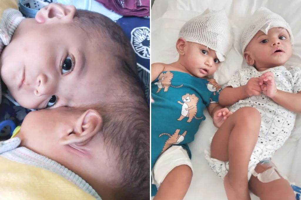 Conjoined twins born with conjoined brain tissue were separated after a risky operation